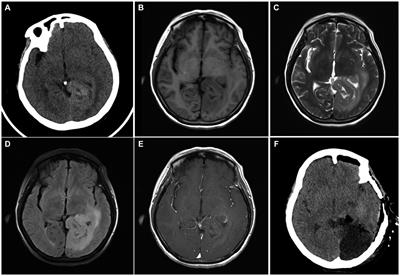 Adult supratentorial extraventricular anaplastic ependymoma with cerebrospinal fluid dissemination metastases: a case report